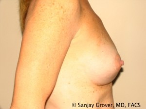 Breast Augmentation Before and After 126 | Grover Aesthetics