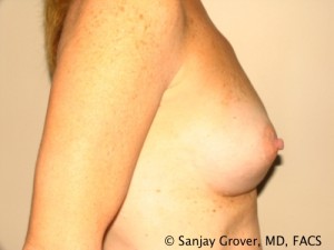 Breast Augmentation Before and After 126 | Sanjay Grover MD FACS