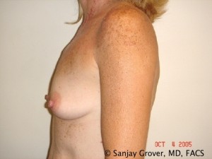 Breast Augmentation Before and After 126 | Grover Aesthetics