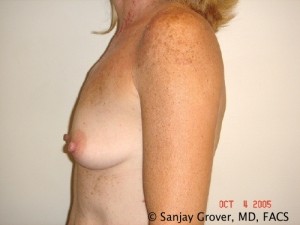 Breast Augmentation Before and After 126 | Sanjay Grover MD FACS