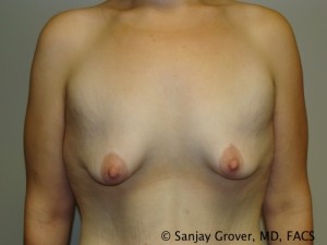 Breast Augmentation Before and After | Grover Aesthetics