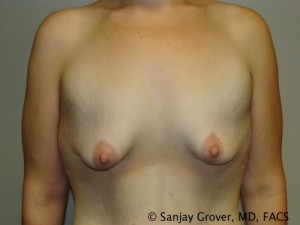 Breast Augmentation Before and After 179 | Sanjay Grover MD FACS