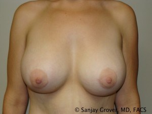 Breast Augmentation Before and After | Grover Aesthetics