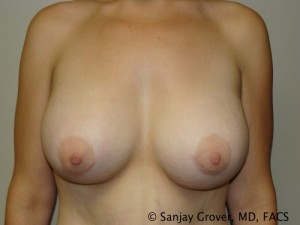 Breast Augmentation Before and After | Sanjay Grover MD FACS