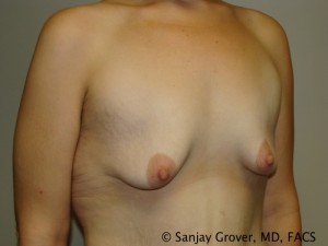 Breast Augmentation Before and After 127 | Grover Aesthetics