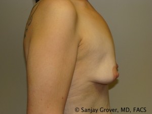 Breast Augmentation Before and After 127 | Grover Aesthetics