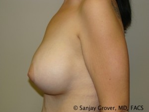 Breast Augmentation Before and After 127 | Grover Aesthetics