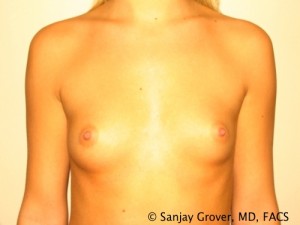 Breast Augmentation Before and After | Sanjay Grover MD FACS