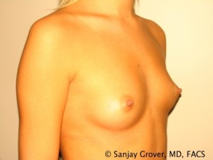 Breast Augmentation Before and After 128 | Grover Aesthetics