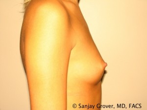 Breast Augmentation Before and After 128 | Grover Aesthetics