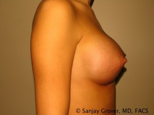 Breast Augmentation Before and After 128 | Sanjay Grover MD FACS