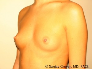 Breast Augmentation Before and After 128 | Sanjay Grover MD FACS