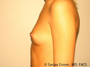 Breast Augmentation Before and After 128 | Grover Aesthetics