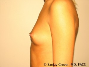 Breast Augmentation Before and After 128 | Sanjay Grover MD FACS