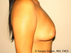 Breast Augmentation Before and After 129 | Grover Aesthetics