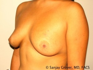 Breast Augmentation Before and After 129 | Grover Aesthetics