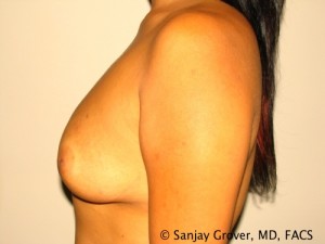 Breast Augmentation Before and After 129 | Grover Aesthetics