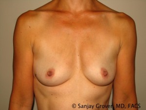 Breast Augmentation Before and After 190 | Sanjay Grover MD FACS