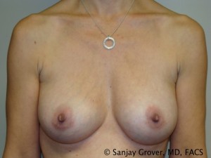 Breast Augmentation Before and After | Sanjay Grover MD FACS