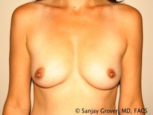 Breast Augmentation Before and After 163 | Sanjay Grover MD FACS