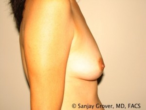 Breast Augmentation Before and After 130 | Grover Aesthetics