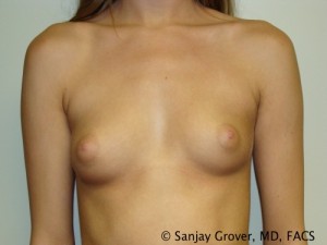 Breast Augmentation Before and After 75 | Sanjay Grover MD FACS