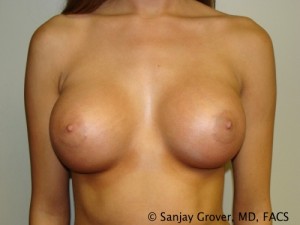 Breast Augmentation Before and After 131 | Sanjay Grover MD FACS