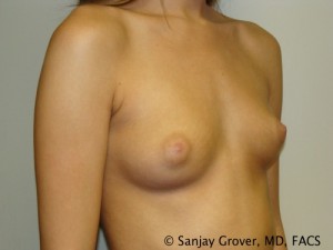 Breast Augmentation Before and After 131 | Grover Aesthetics