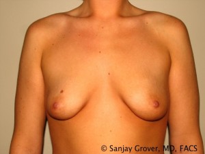 Breast Augmentation Before and After 243 | Sanjay Grover MD FACS