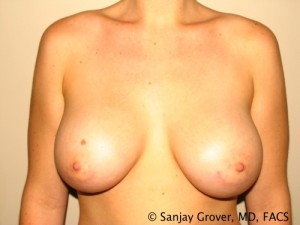 Breast Augmentation Before and After | Grover Aesthetics