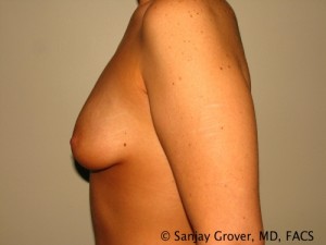 Breast Augmentation Before and After 133 | Grover Aesthetics