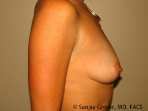 Breast Augmentation Before and After 134 | Grover Aesthetics