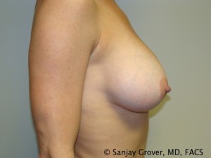 Breast Augmentation Before and After 134 | Grover Aesthetics