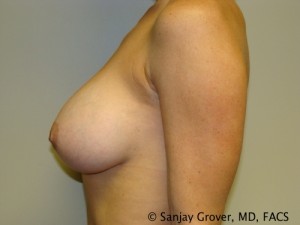 Breast Augmentation Before and After 134 | Grover Aesthetics