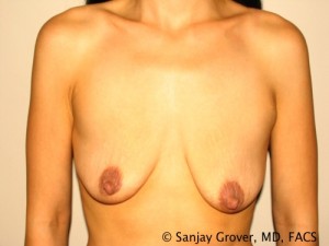 Breast Augmentation Before and After | Grover Aesthetics