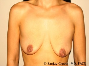 Breast Augmentation Before and After 99 | Sanjay Grover MD FACS