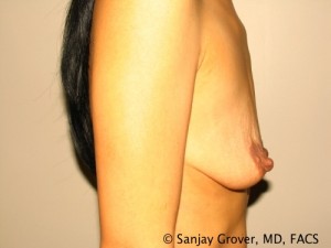 Breast Augmentation Before and After 135 | Grover Aesthetics