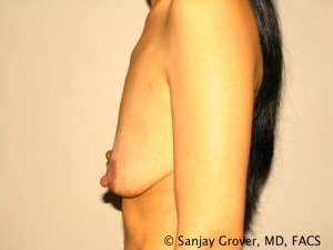 Breast Augmentation Before and After 135 | Grover Aesthetics