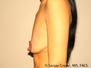 Breast Augmentation Before and After 135 | Sanjay Grover MD FACS