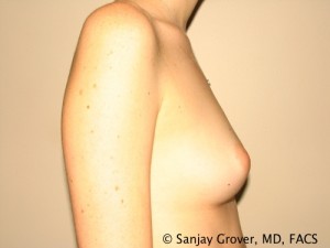 Breast Augmentation Before and After 137 | Grover Aesthetics