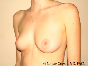 Breast Augmentation Before and After 137 | Grover Aesthetics