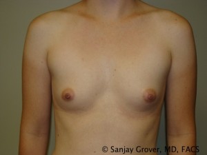 Breast Augmentation Before and After | Grover Aesthetics