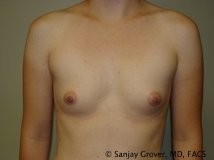 Breast Augmentation Before and After 179 | Sanjay Grover MD FACS