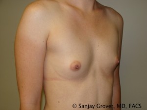 Breast Augmentation Before and After 138 | Grover Aesthetics