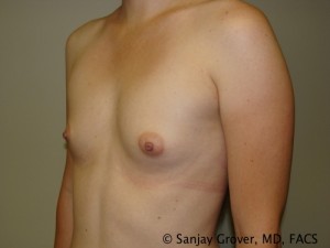 Breast Augmentation Before and After 138 | Grover Aesthetics