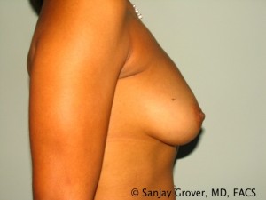 Breast Augmentation Before and After 139 | Grover Aesthetics