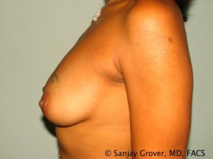 Breast Augmentation Before and After 139 | Grover Aesthetics