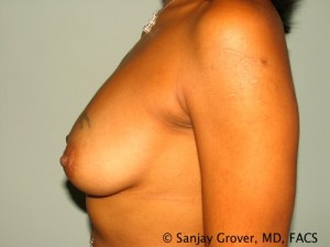 Breast Augmentation Before and After 139 | Sanjay Grover MD FACS