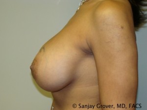 Breast Augmentation Before and After 139 | Grover Aesthetics