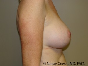 Breast Augmentation Before and After 140 | Sanjay Grover MD FACS
